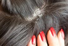 Chia sẻ 5 cách trị gàu và ngứa da đầu tại nhà hiệu quả