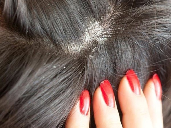 Chia sẻ 5 cách trị gàu và ngứa da đầu tại nhà hiệu quả